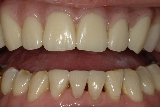 cosmetic bonding and hybrid denture after ALLEN, TX