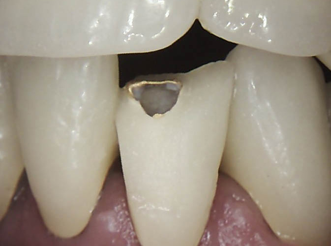 dental crown before and after ALLEN, TX