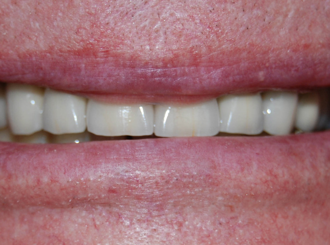 Extreme wear on upper teeth and after crown on upper teeth ALLEN, TX