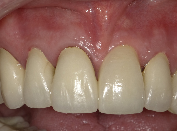 implant before and after ALLEN, TX