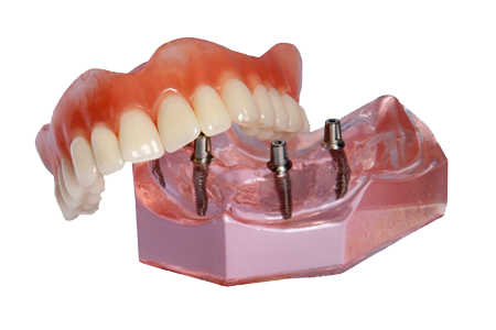 implant supported denture model ALLEN, TX