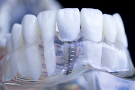 dental implant model ALLEN, TX