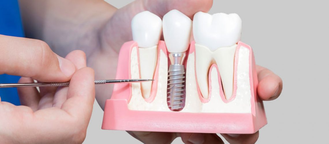 Dental Assistant Showing Off A Dental Implant In A Jawbone Cutaway Model in Allen, TX
